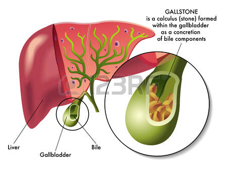 51060763-stock-vector-gallstones.jpg?ver