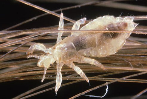 head_lice_s1_louse_on_human_hair.jpg